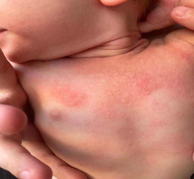 乳児期のアトピー性皮膚炎