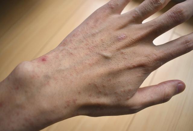アトピー性皮膚炎の脱ステロイドの症状